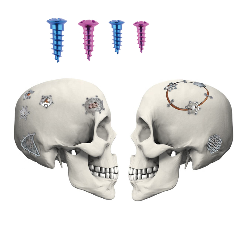 Craniomaxillofacial (CMF) Implants